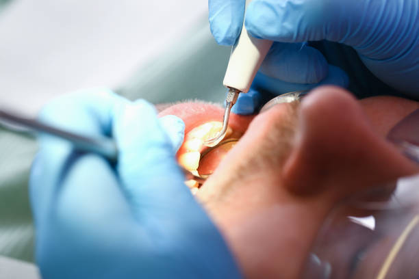 Best Emergency Tooth Extraction in Rio Grande, OH
